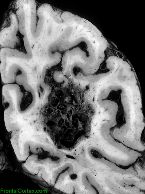 Arteriovenous malformation, coronal section through posterior parietal lobe